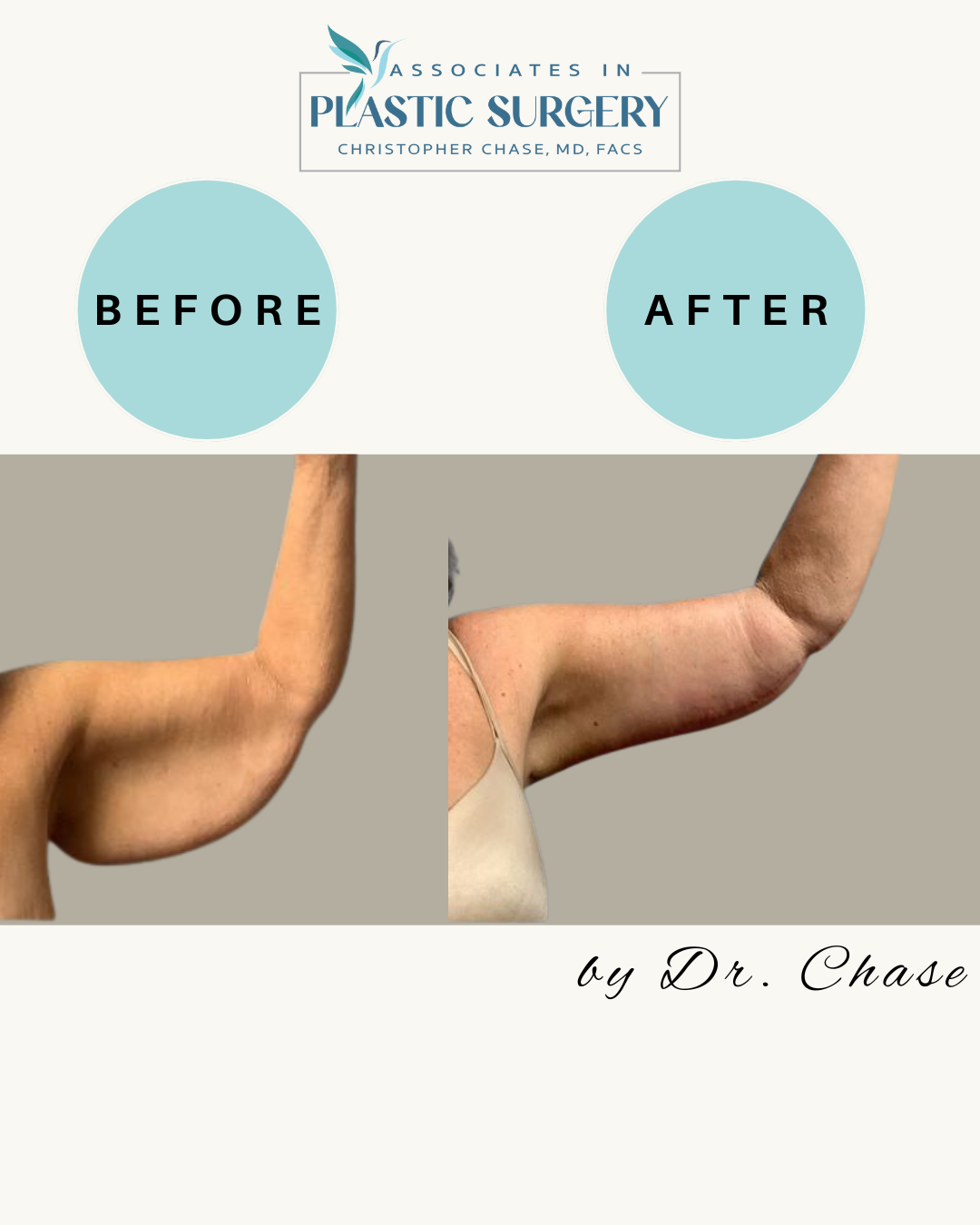Before and after photos of arm lift surgery. Flabby arm before; toned arm after.