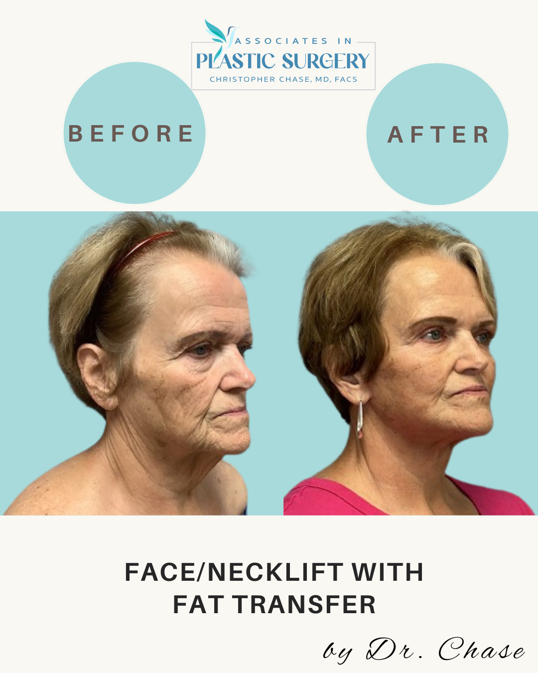 Before and after facial rejuvenation comparison. Woman's face/necklift with fat transfer.