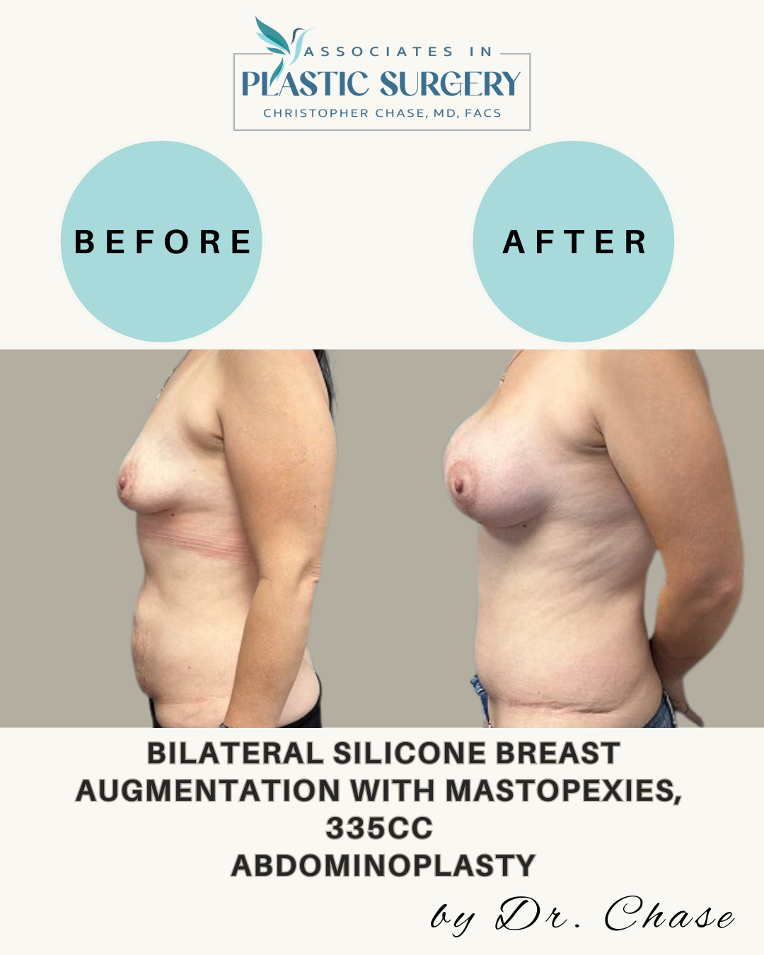 Before-and-after of a breast augmentation and abdominoplasty.