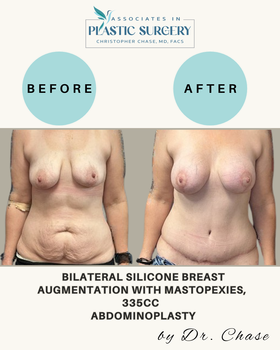 Side-by-side comparison of a woman's torso, before and after breast augmentation, mastopexy, and abdominoplasty.