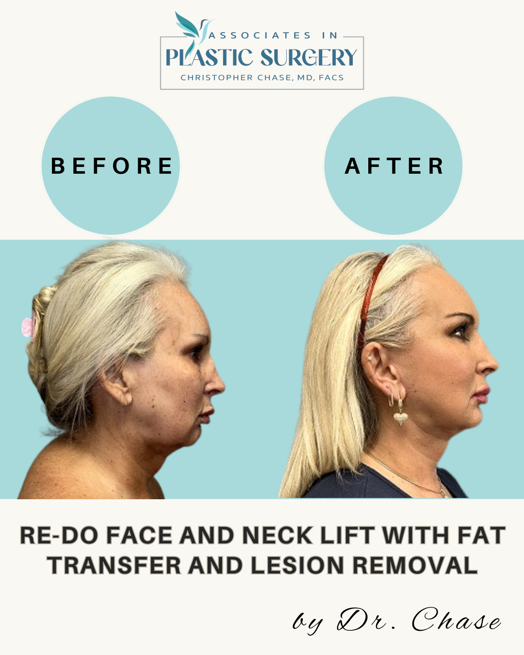 Before-and-after of a woman’s face. After a neck and face lift, the woman has a more defined jawline.