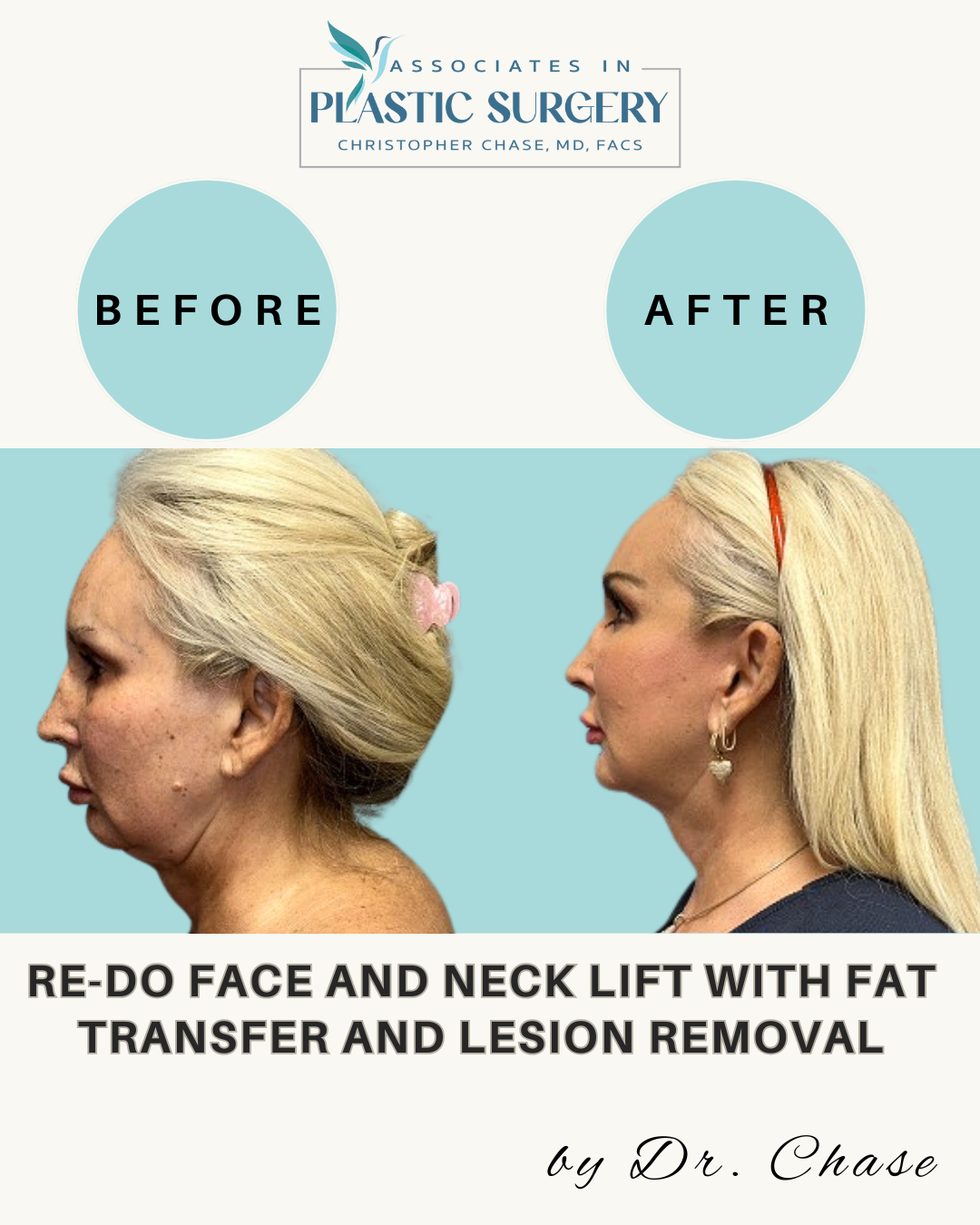 Side-by-side comparison of a woman's face before and after a face/neck lift, with fat transfer and lesion removal.