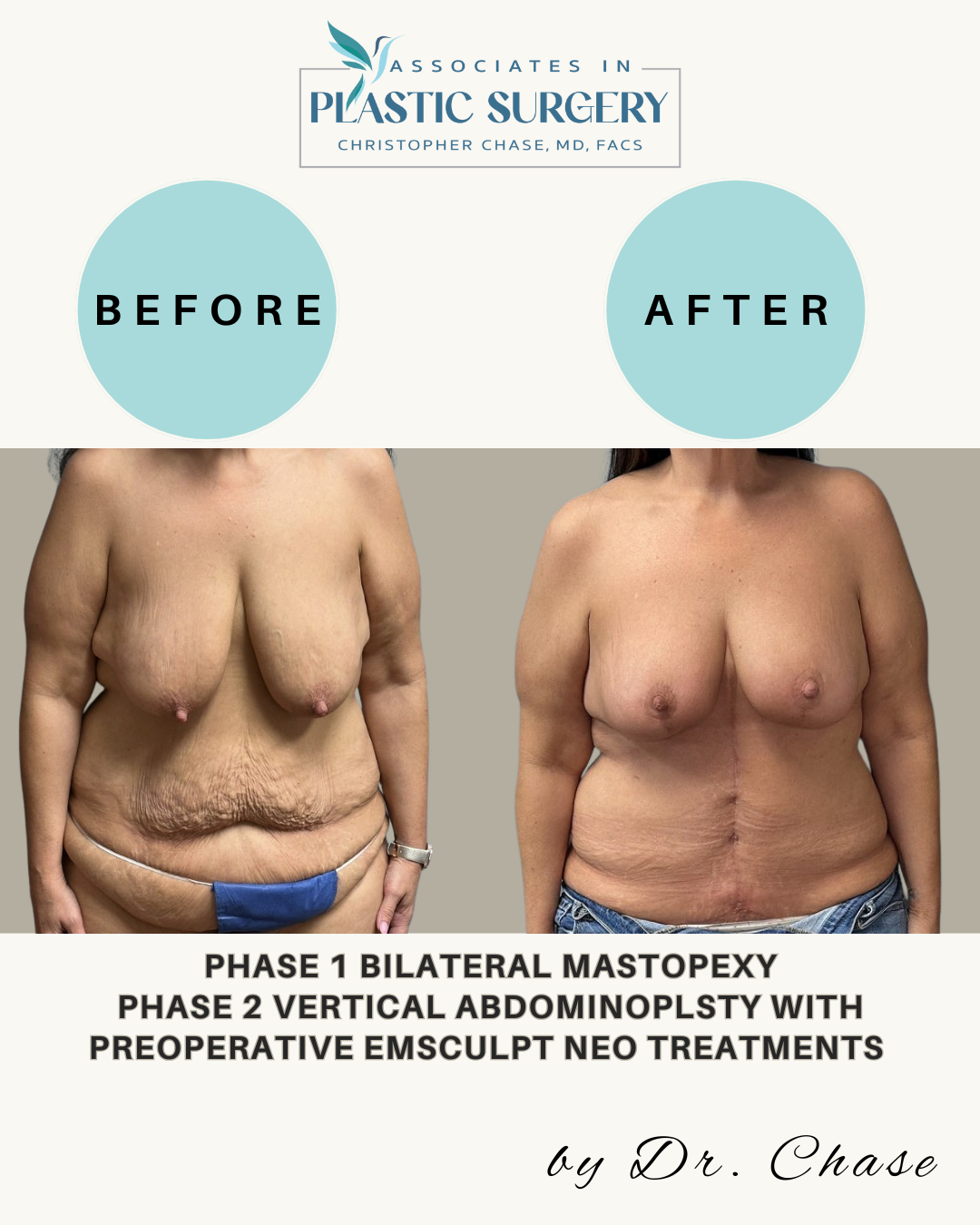 Before and after photos showing a woman's breast lift and tummy tuck.