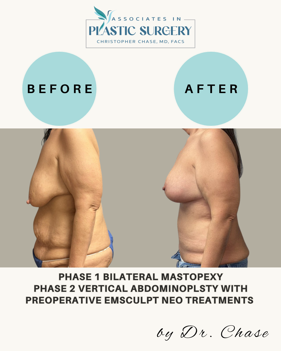 Before and after photos showing results of a bilateral mastopexy and vertical abdominoplasty.
