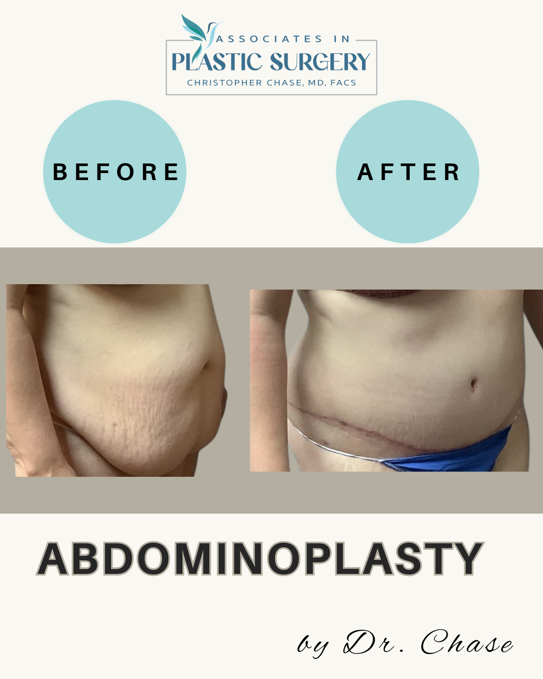 Before and after abdominoplasty photos; showing changes in the abdomen and a scar. Light blue background.