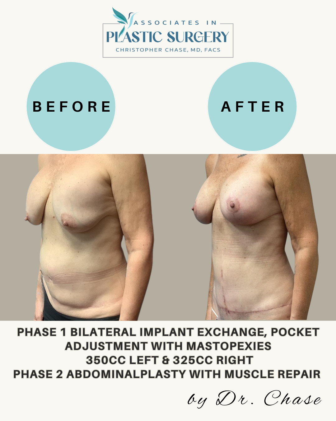 Before and after photos of a person's chest and abdomen following surgery.
