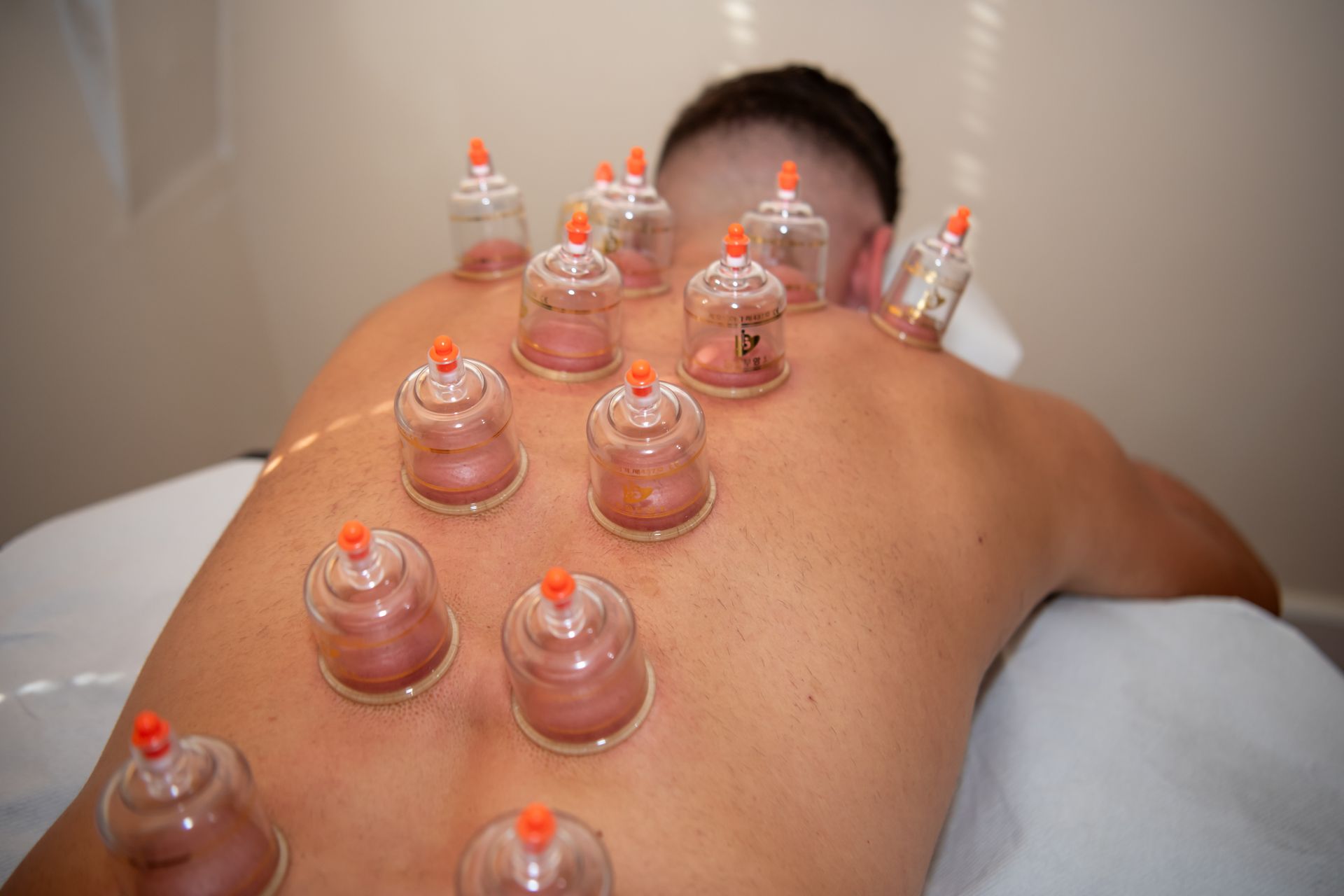 Dry cupping therapy Balbriggan