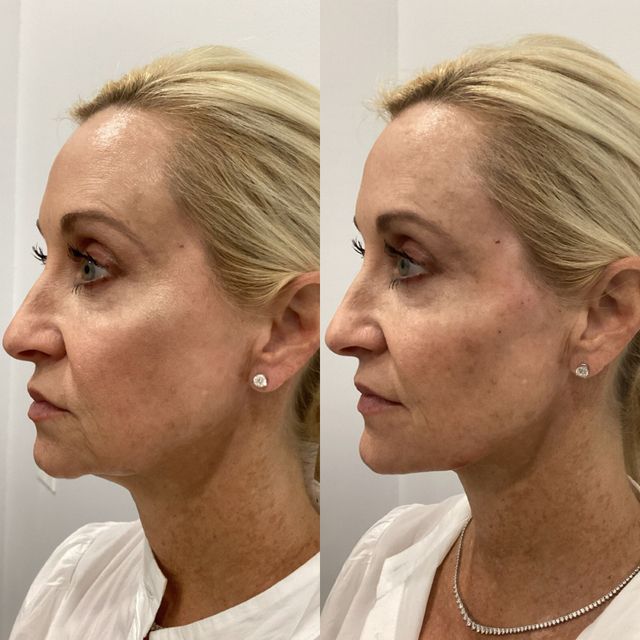 glow glutathione skin station Radiant with DERMAXPro Capsules Pack Size:45 days pack BASE 5-Amino-1MQ (Cl)