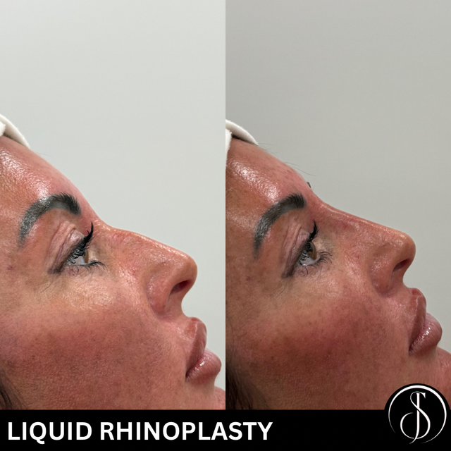 glutathione baton rouge la Liquid Rhinoplasty in Rouge: A Non-Surgical Nose Job Alternative Skin elasticity Size:4 96-Well Plates Holland & Barrett L-Glutamine