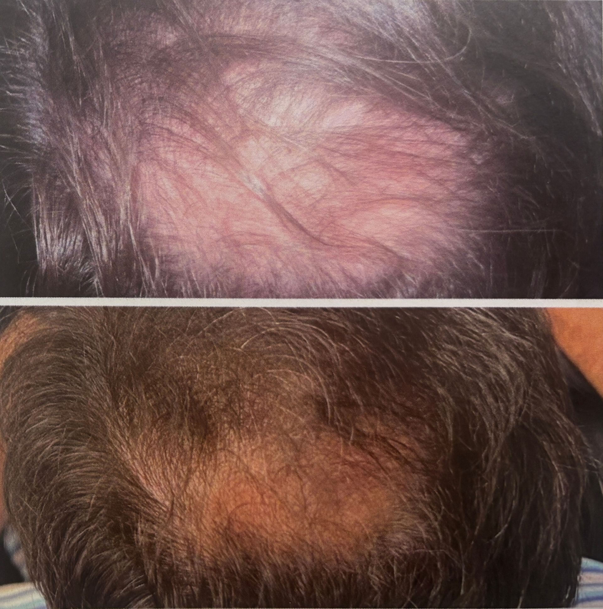 Top: balding scalp with sparse dark hair. Bottom: fuller scalp with dark hair.