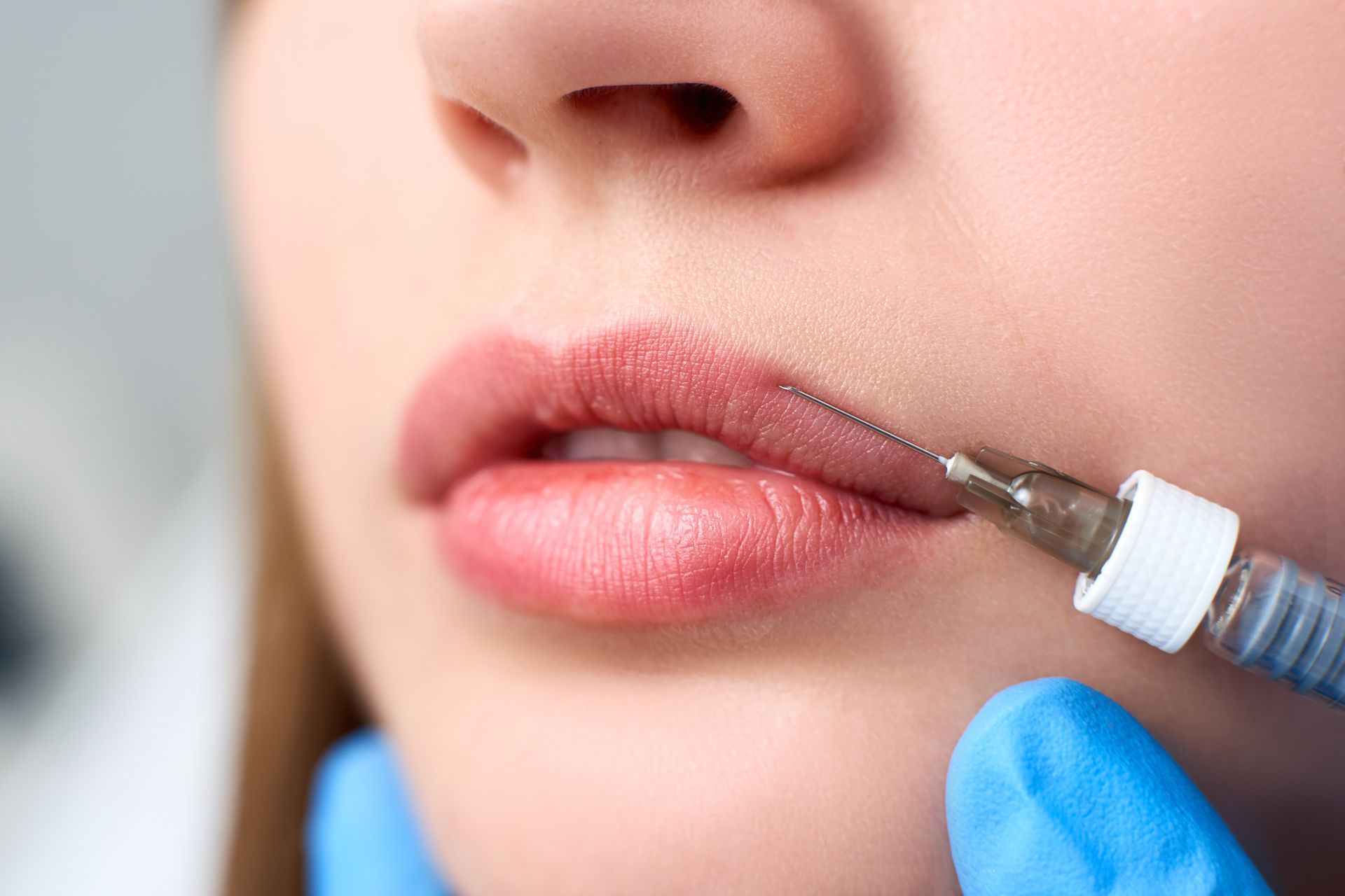Lips receiving a filler injection. A needle is inserted into the upper lip by a gloved hand.