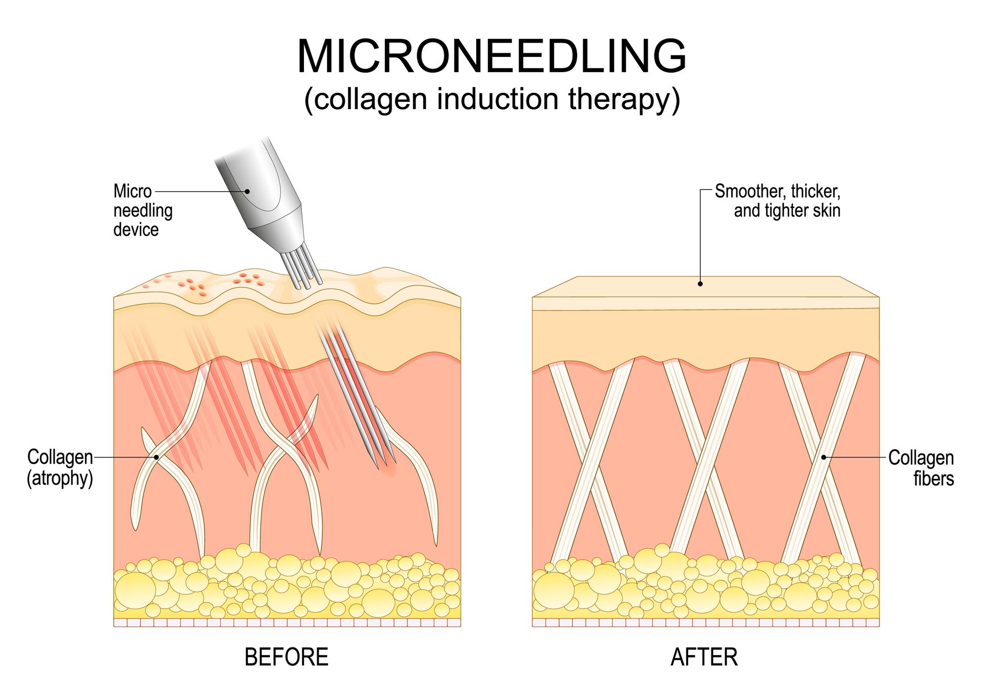 Diagram: Microneedling before and after. Shows device puncturing skin, increasing collagen, resulting in smoother, tighter skin.