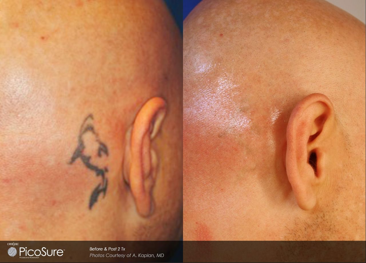 A before and after photo of a man with a tattoo on his head