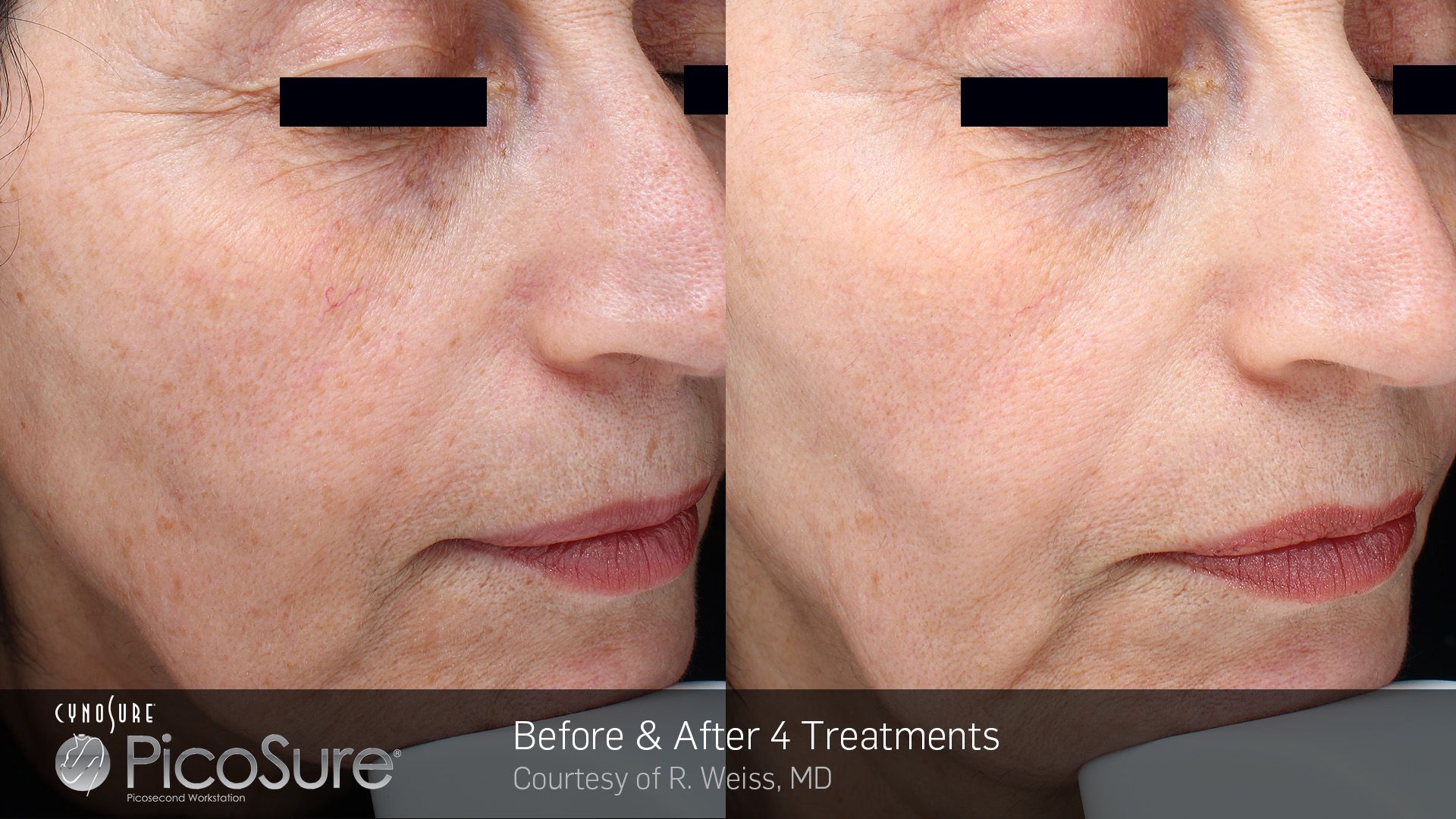 A before and after photo of a woman 's face.