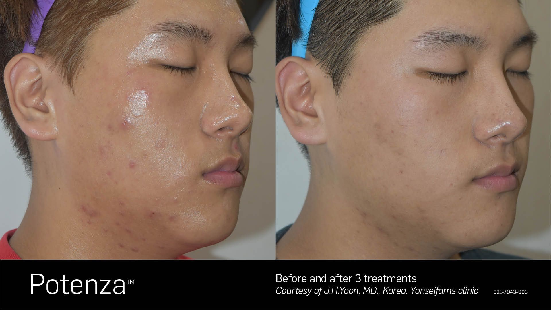 A before and after photo of a man 's face with acne.