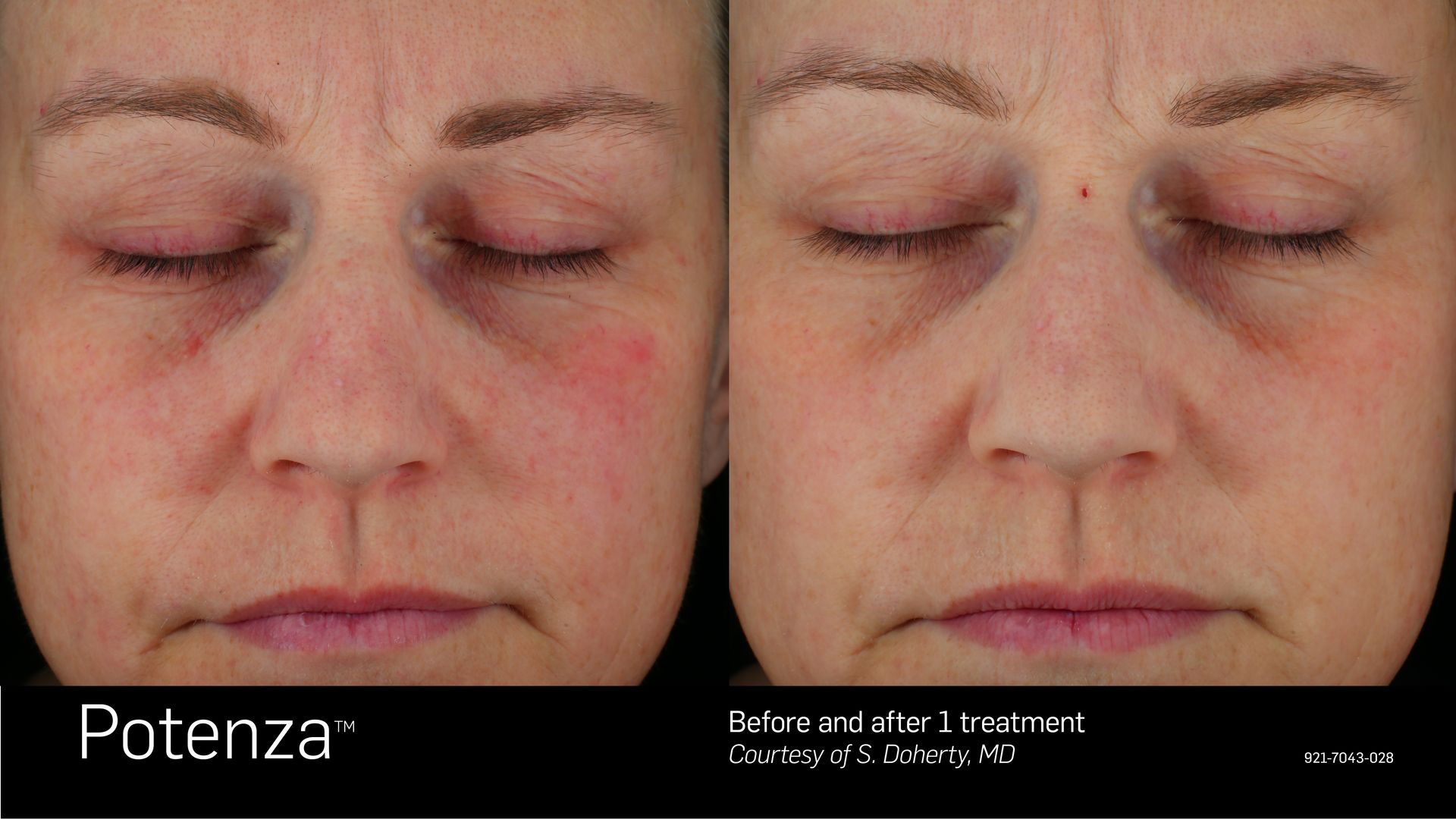 A before and after photo of a woman 's face with a black eye.