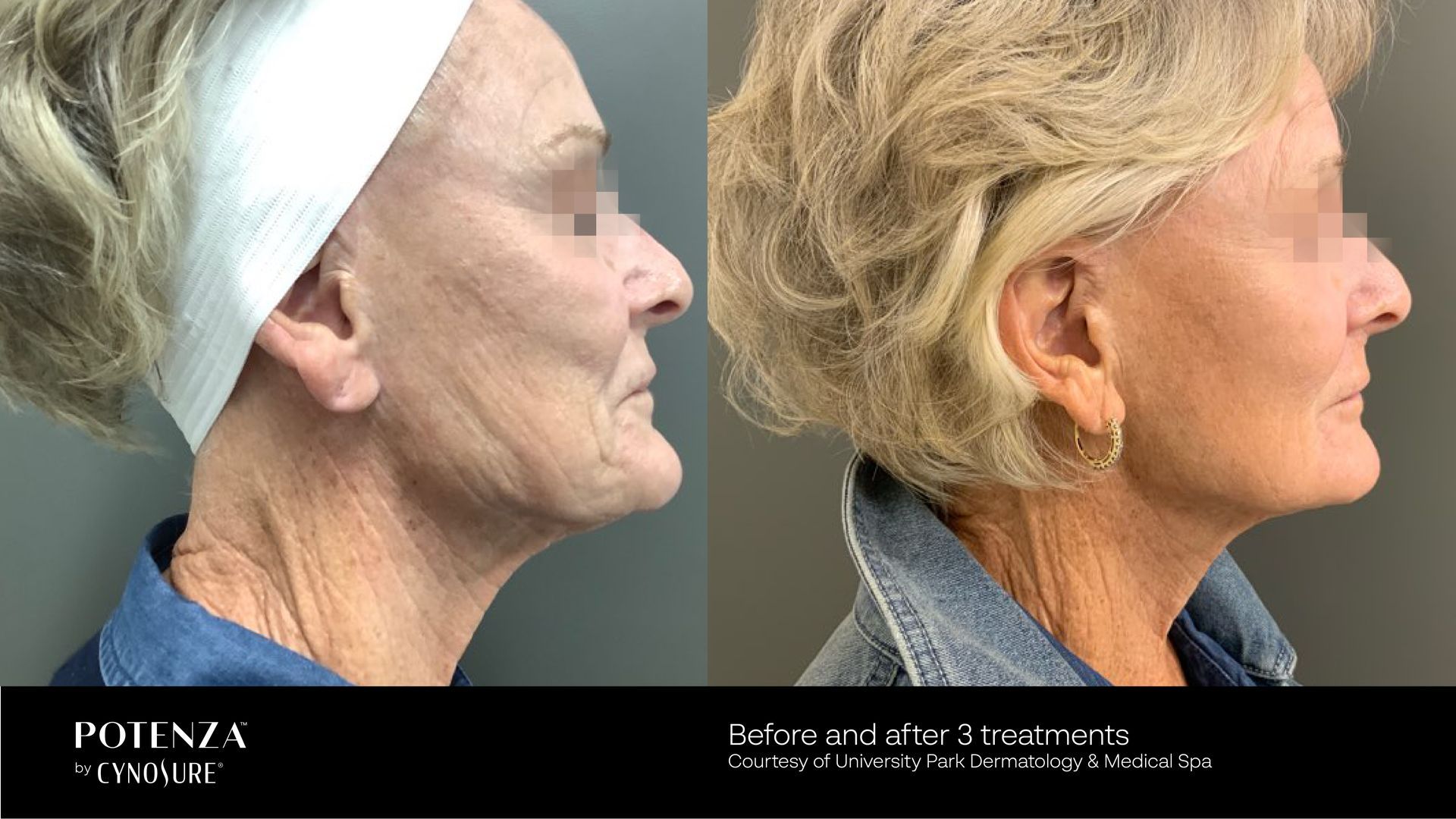 A before and after photo of a woman 's face and neck.
