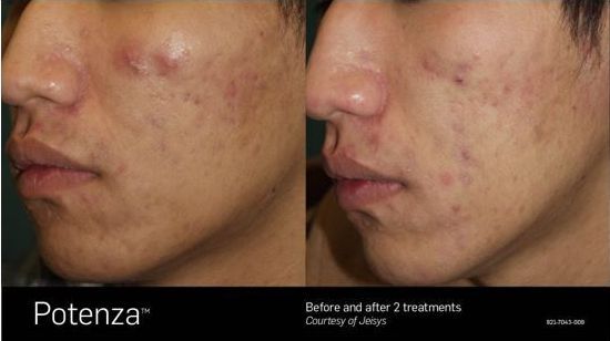 A before and after photo of a person 's face with acne