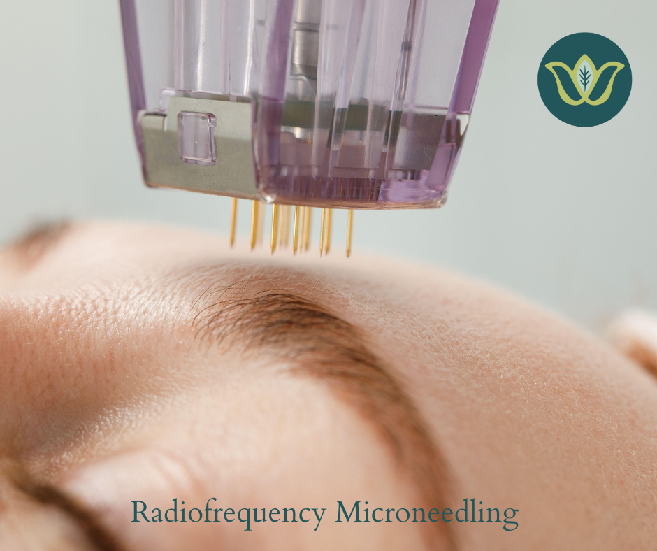 A close-up shows radiofrequency microneedling on a person's eyebrow and forehead with the device's needles touching the skin.