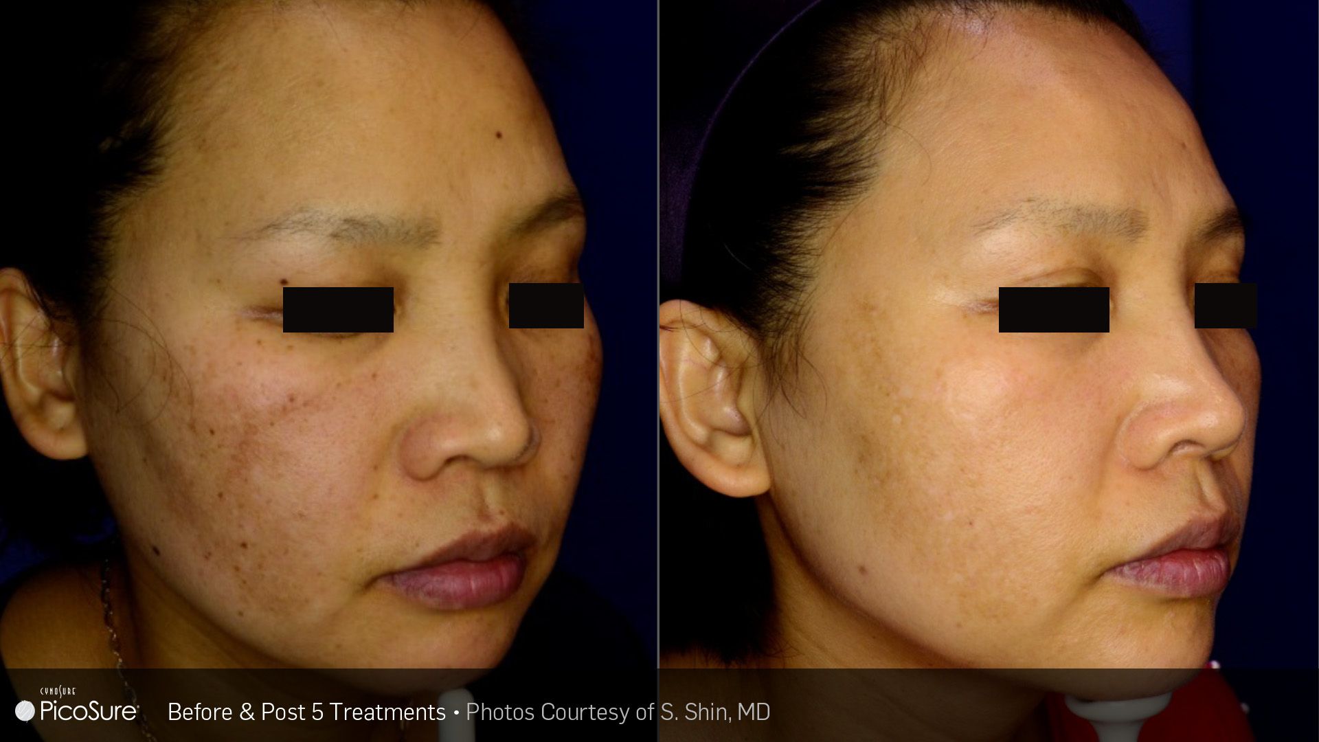 A before and after photo of a woman 's face