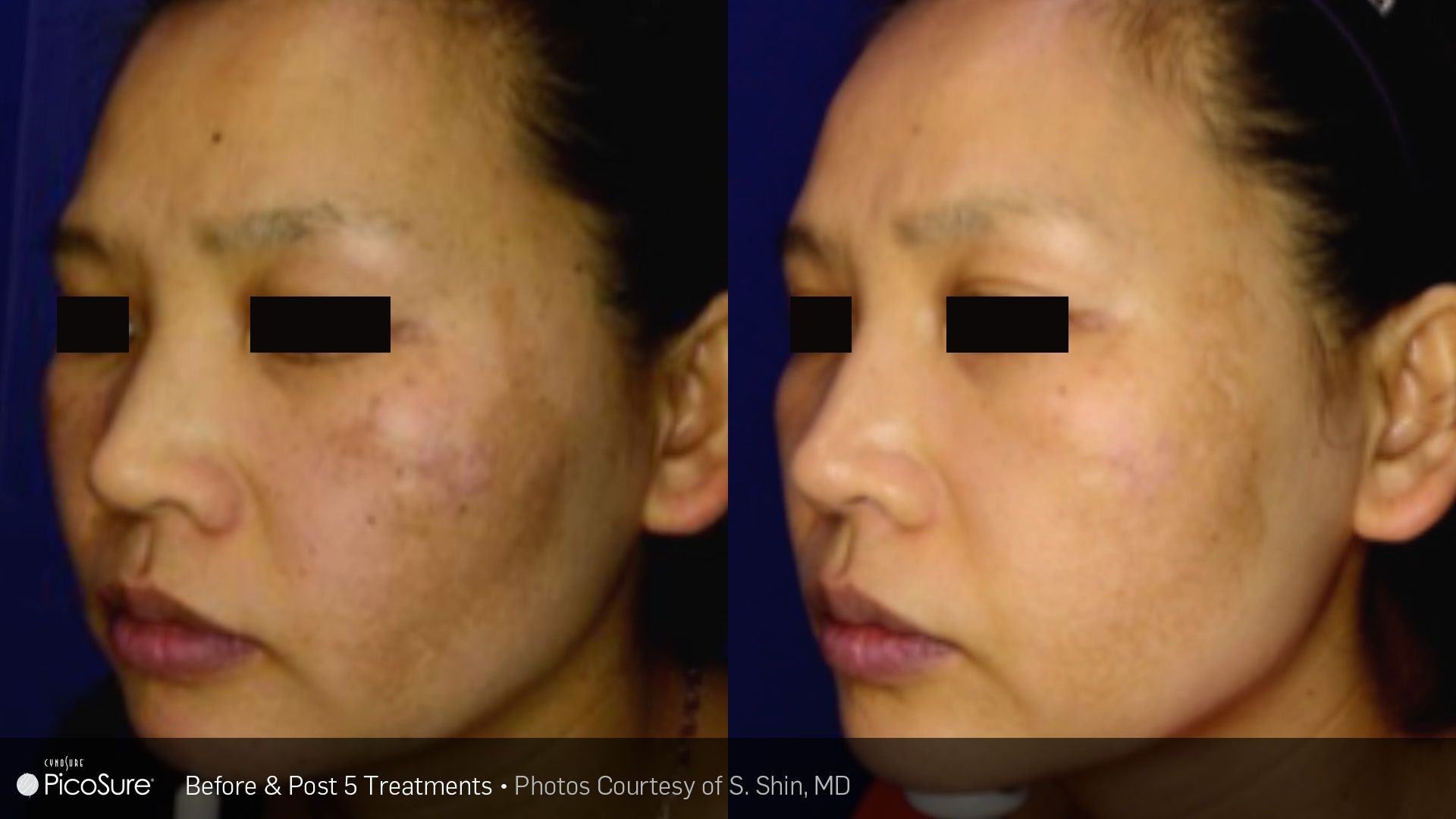 A before and after photo of a woman 's face