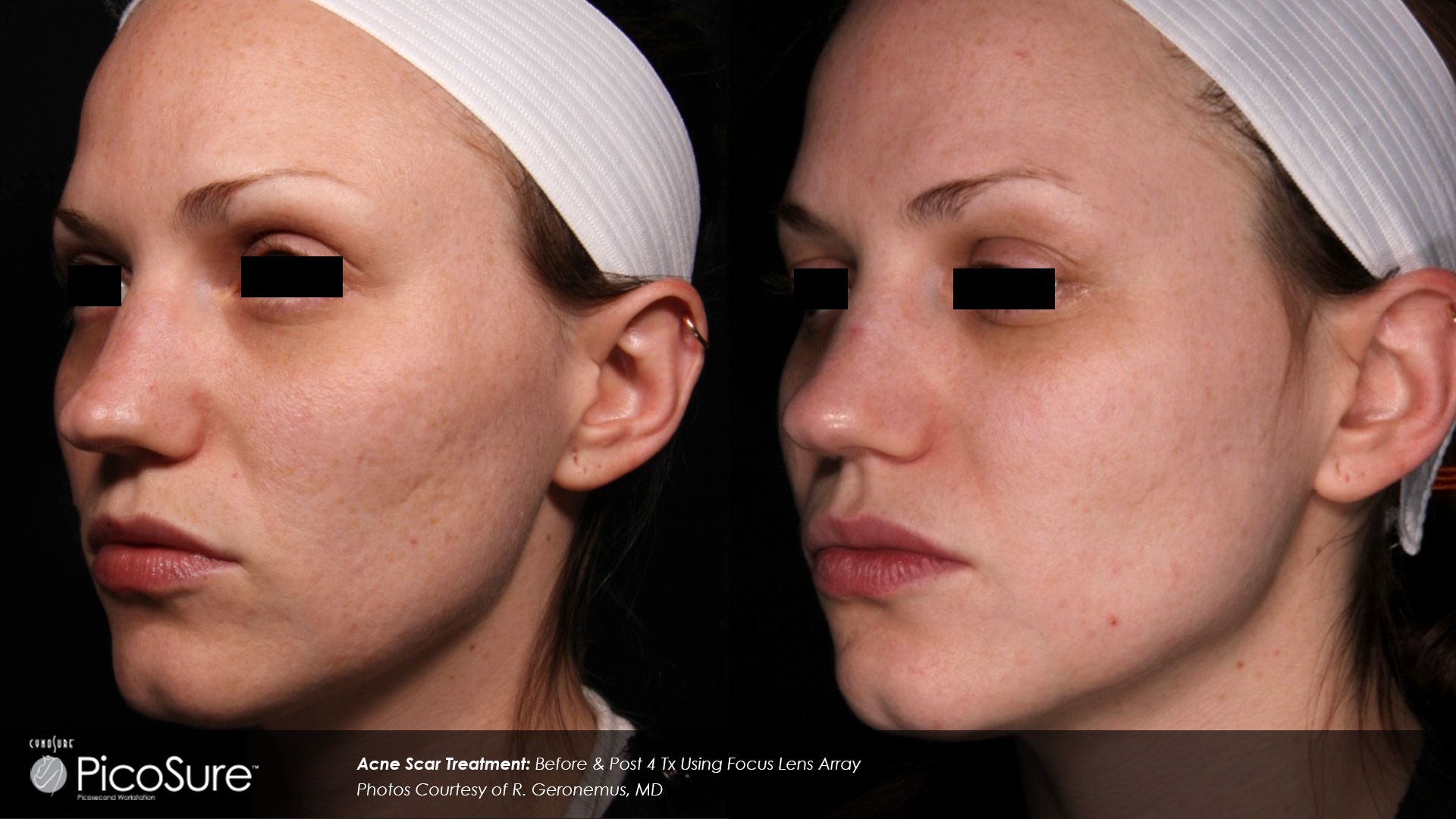 A before and after photo of a woman 's face