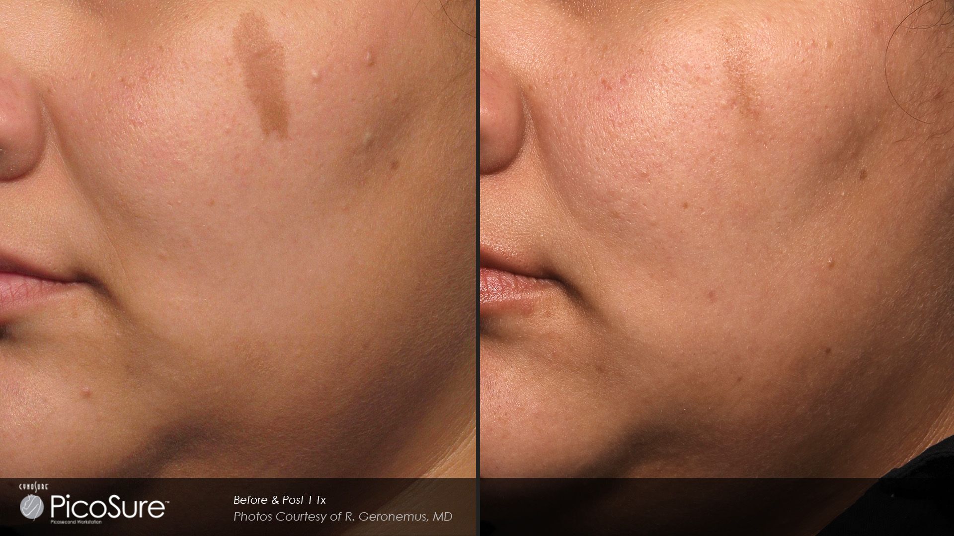 A before and after photo of a woman 's face with spots on it.