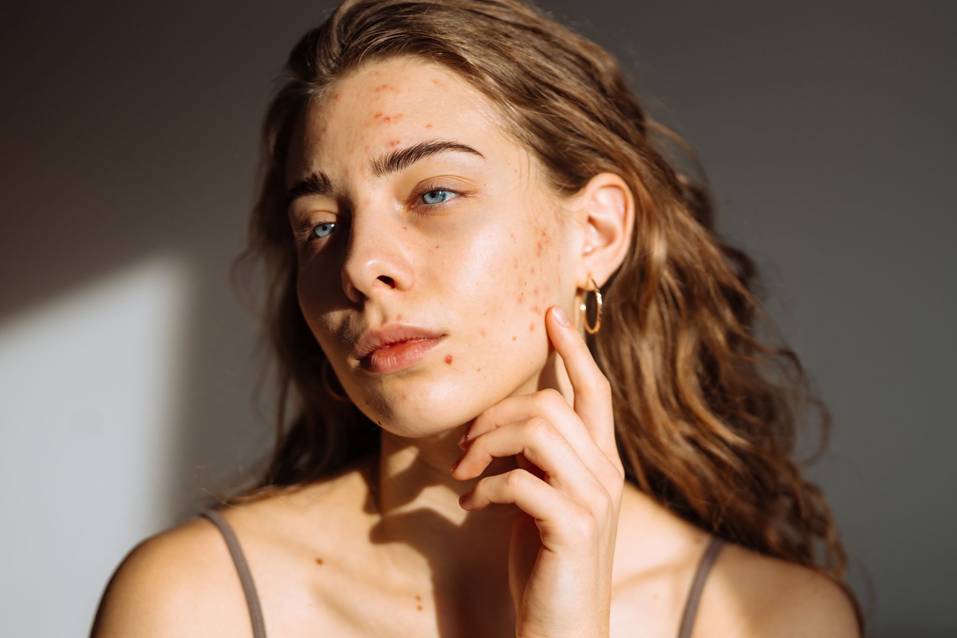 A young woman with light skin and curly brown hair touches her cheek. She has freckles and blemishes and is lit by sunlight.