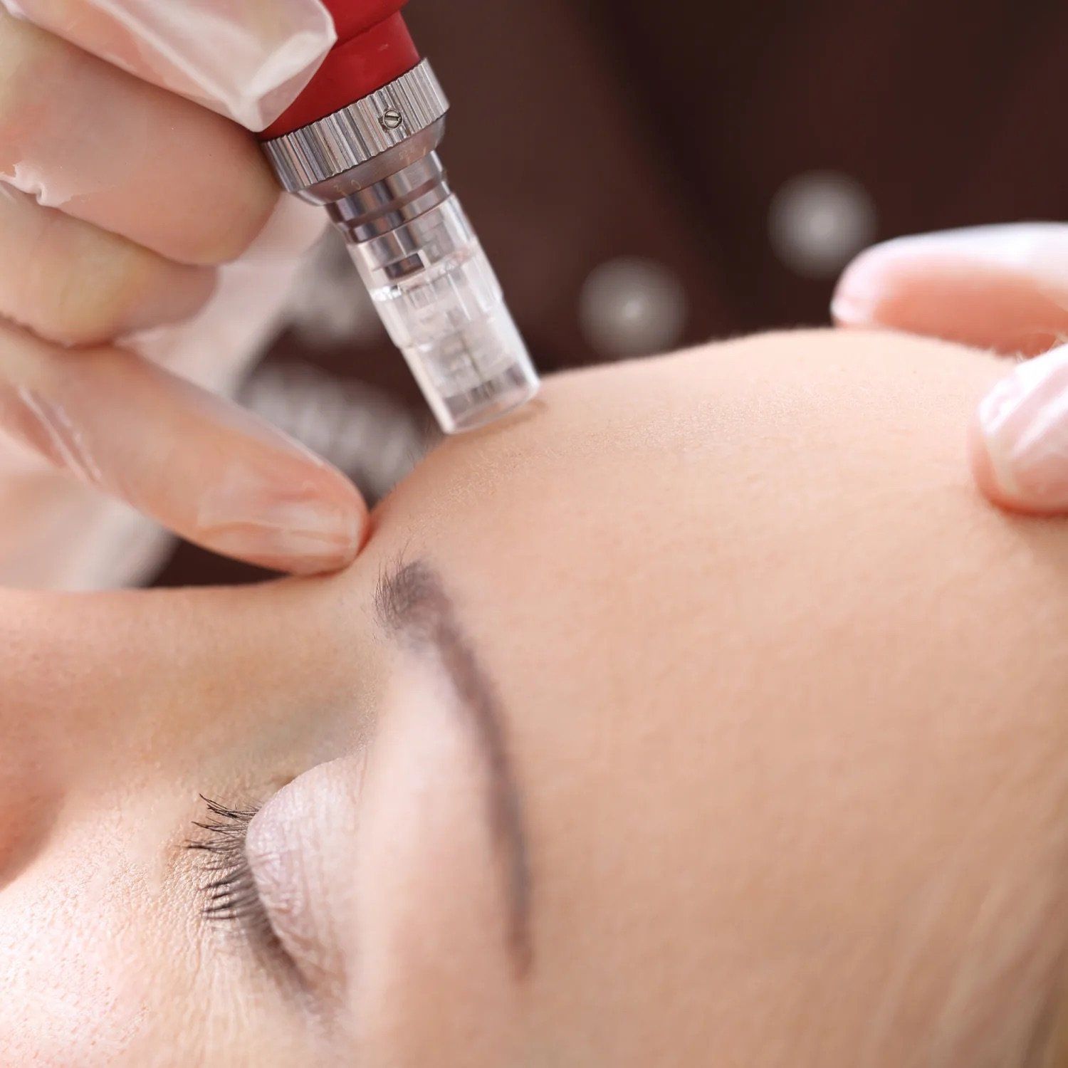 Mirco needling