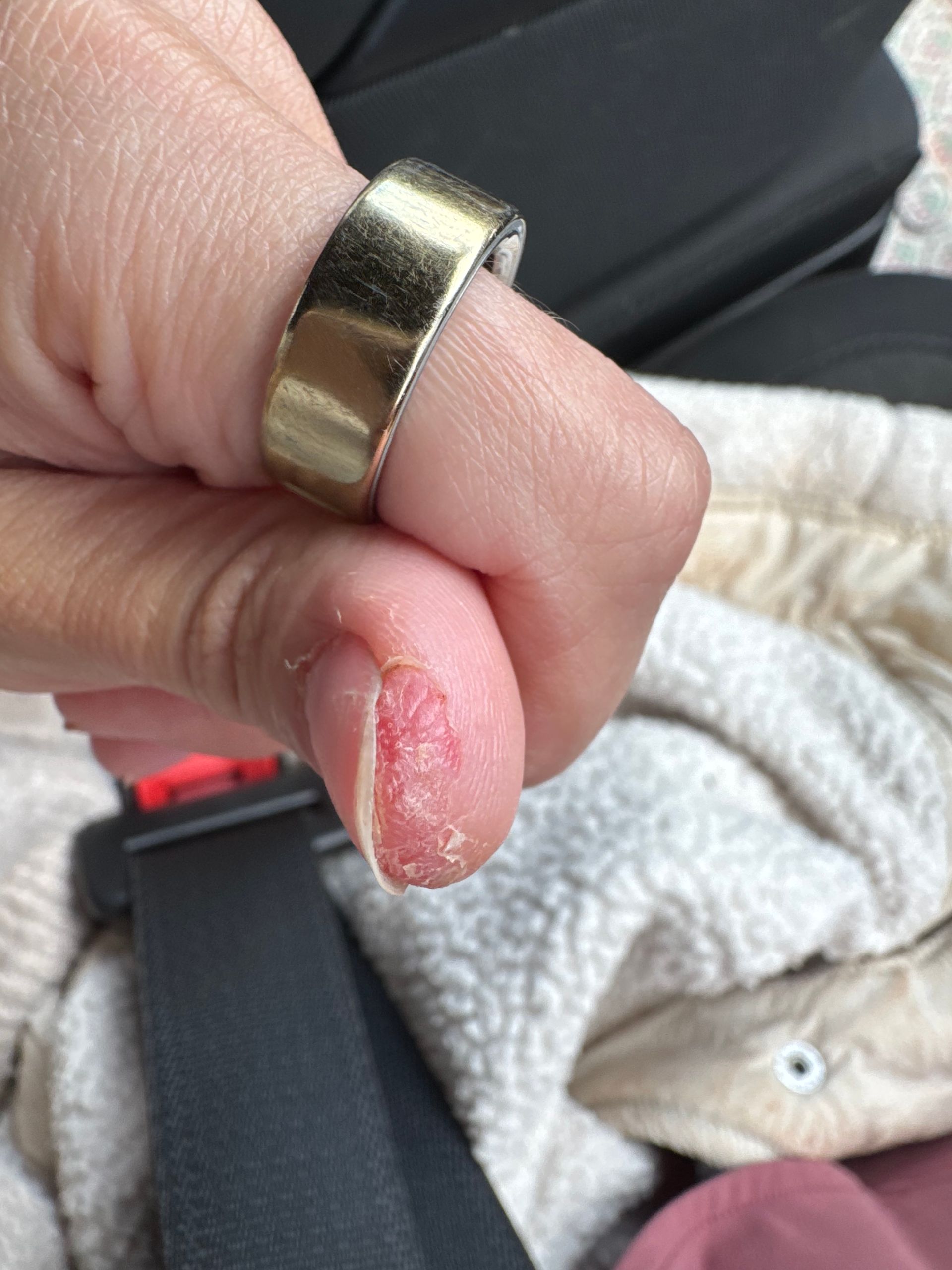 blistering of skin