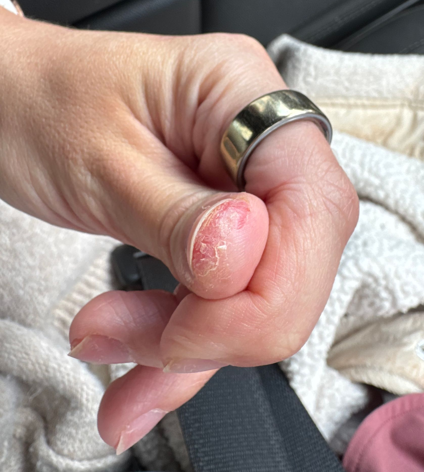 allergic reaction to gel nail polish