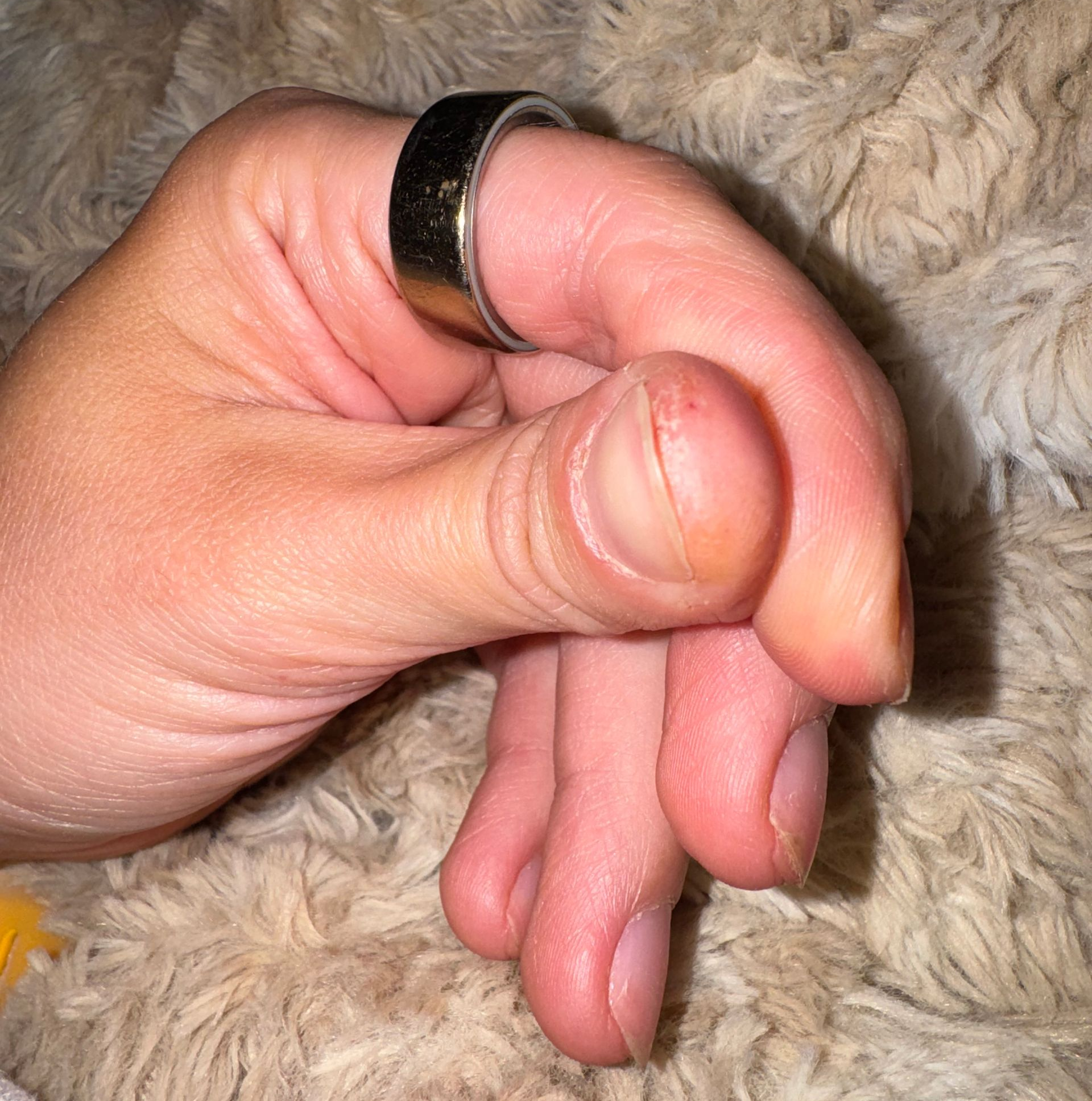 allergic dermatitis