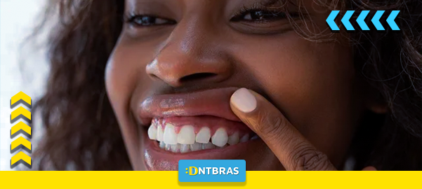 Gengivas; Gengivas saudáveis; dentistas; Saúde bucal; DNTBRAS