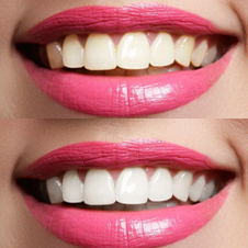 Clareamento dental
