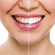 Facetas dentárias