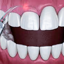Gengivoplastia