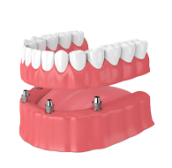 implante com prótese overdenture