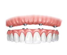 um close de uma dentadura com aparelho.