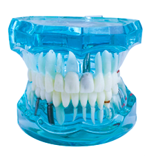 Implante dentário