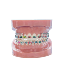 um modelo dos dentes de uma pessoa com aparelho.