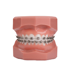 um modelo dos dentes de uma pessoa com aparelho