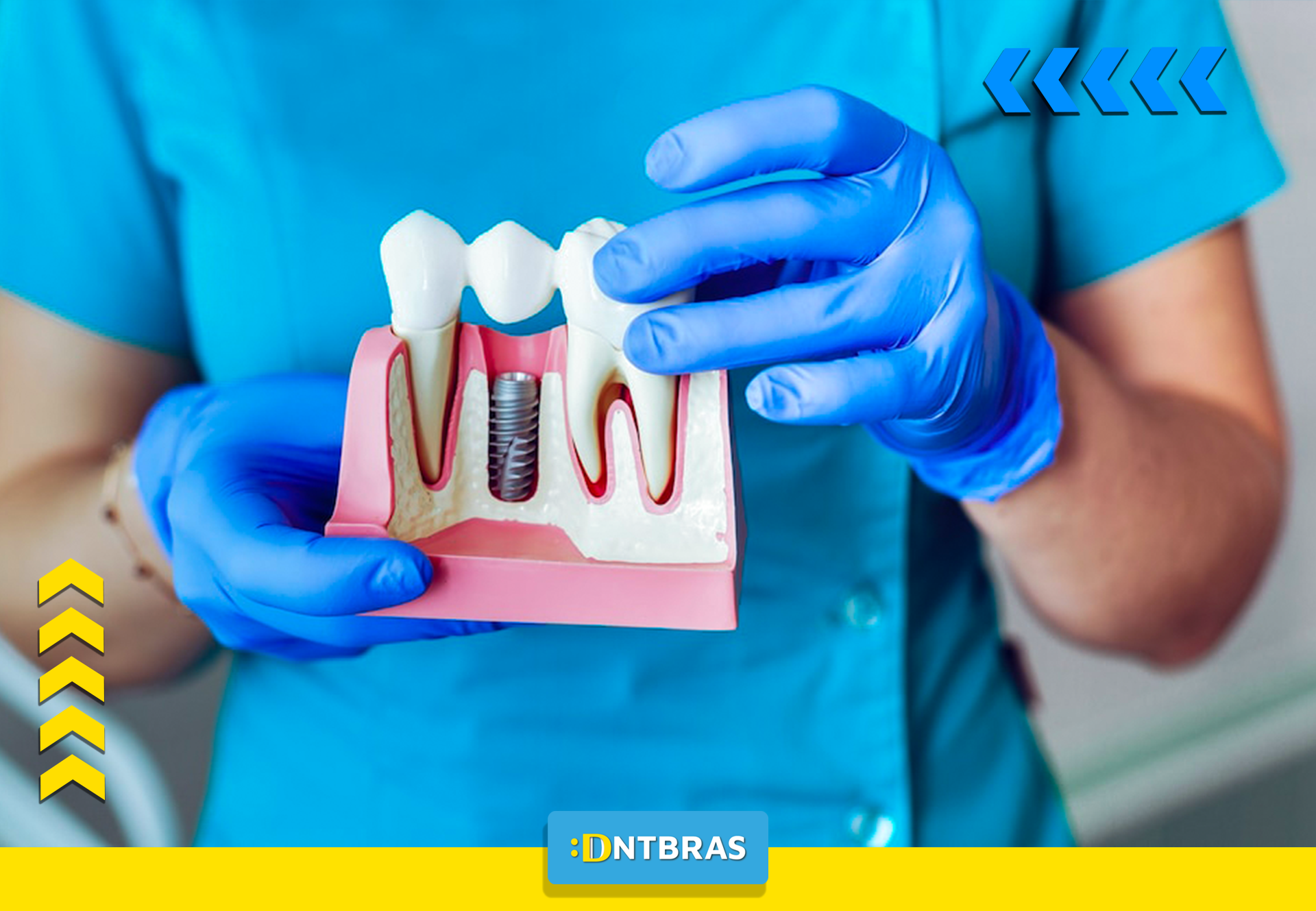 um dentista está segurando um modelo de dente com um implante.