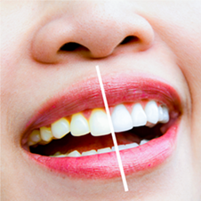 um close da boca de uma mulher com uma linha branca entre os dentes