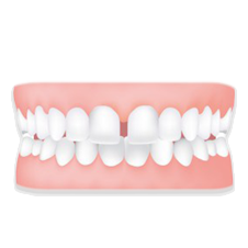 Diastema; aparelho ortodôntico
