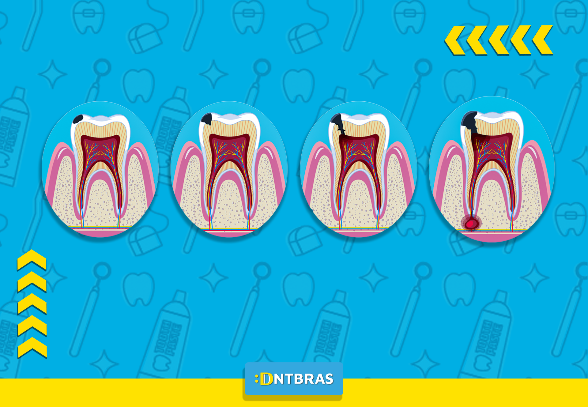 uma ilustração dos desenhos animados de um dente com um buraco nele.