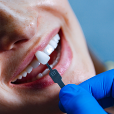 Facetas dentárias