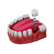 um modelo de dente com um implante dentário.