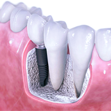 Implantes dentários
