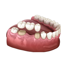 Ponte fixa dentária