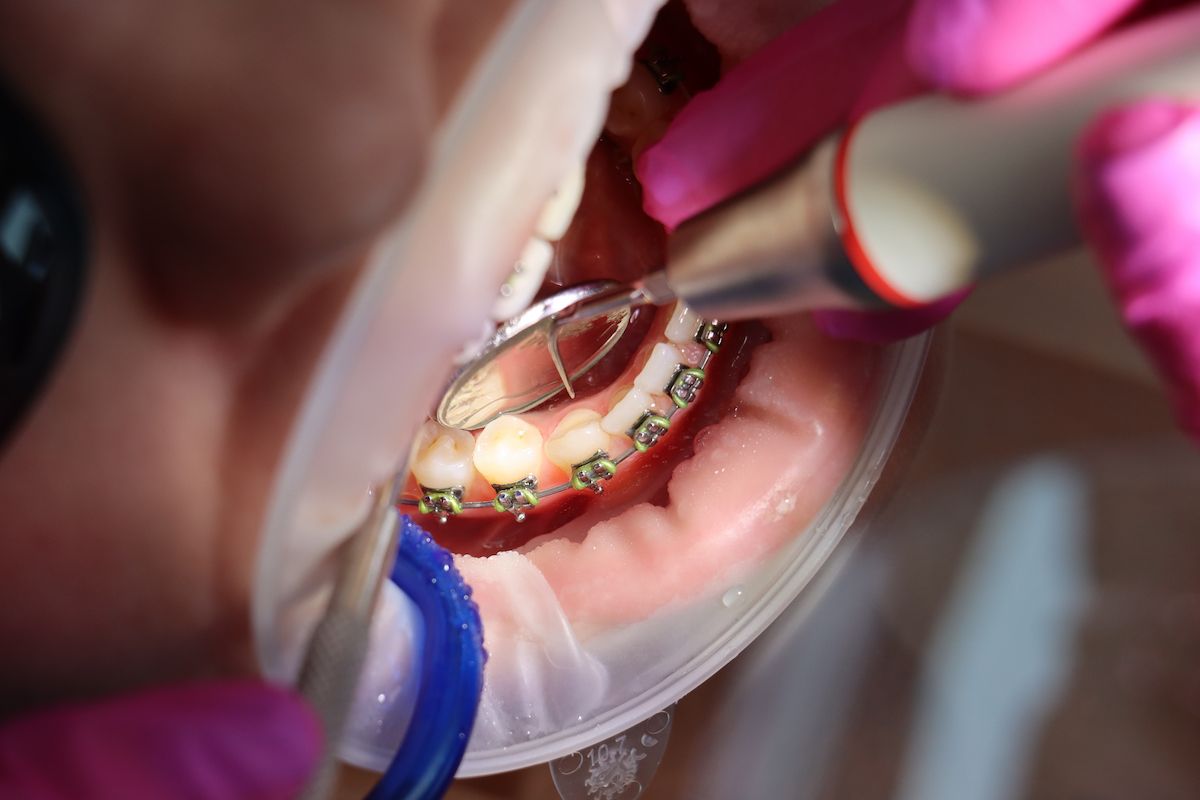 Ein Zahnarzt verwendet zahnärztliche Instrumente an einem Patienten mit Zahnspange im Mund.